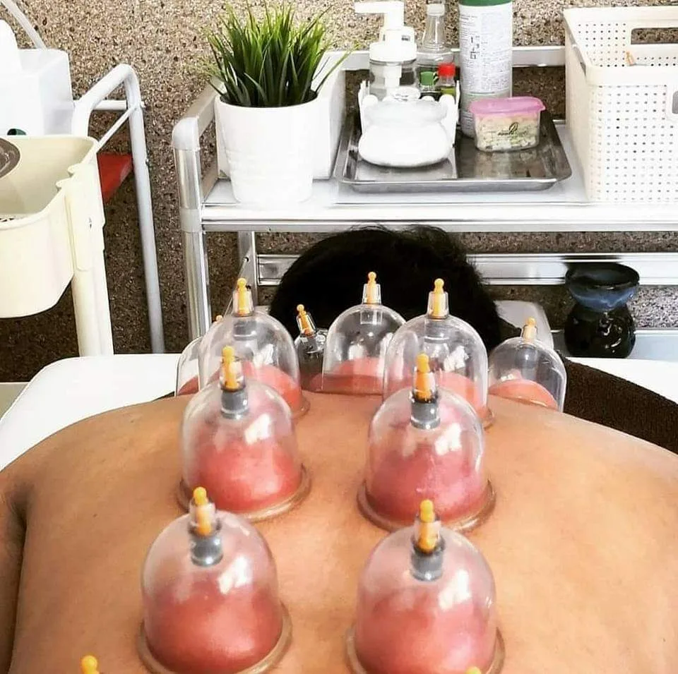 الحجامة الطبية بإتقان وأمآن في قطر مجمع ريحان الطبي