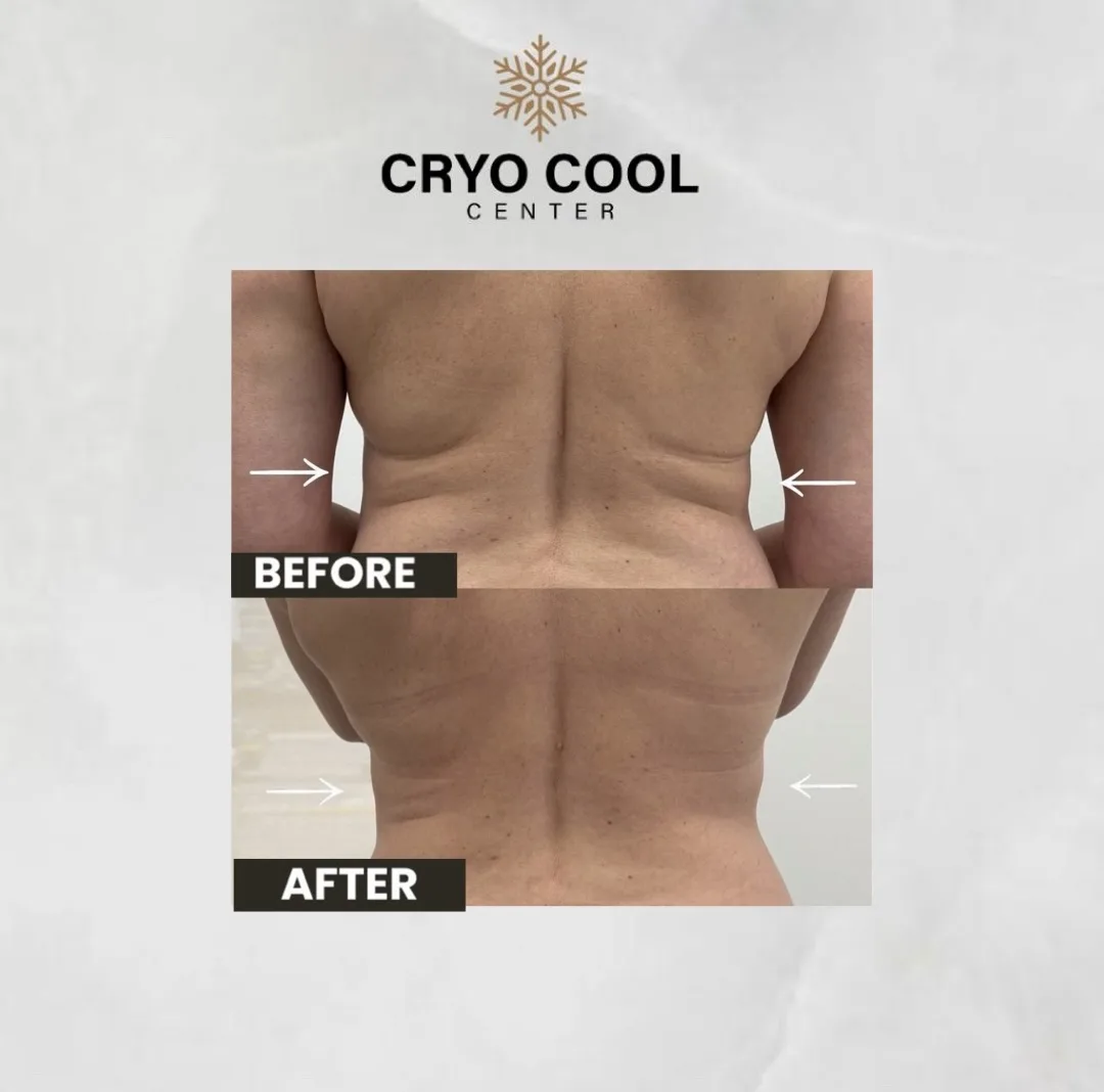 Cryo Cool Center